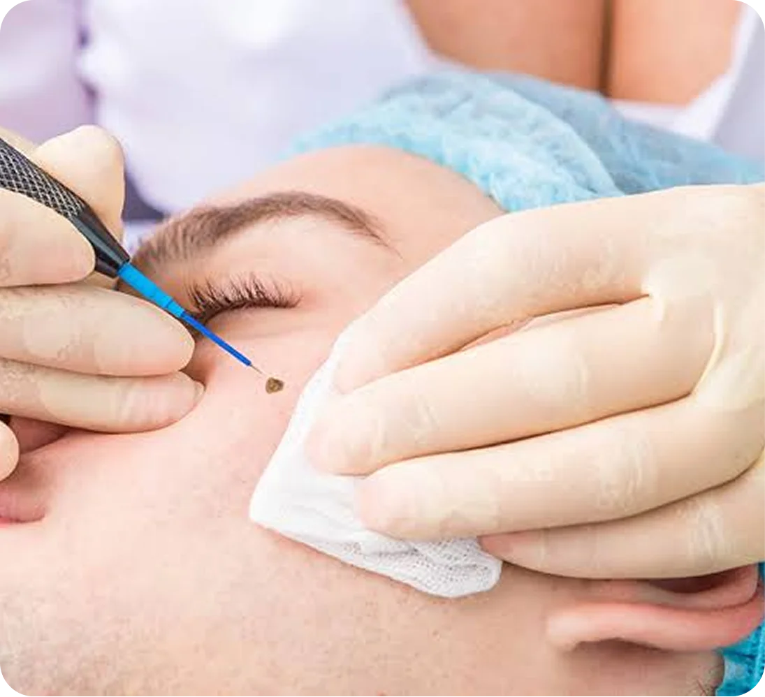 Male Hair Transplant