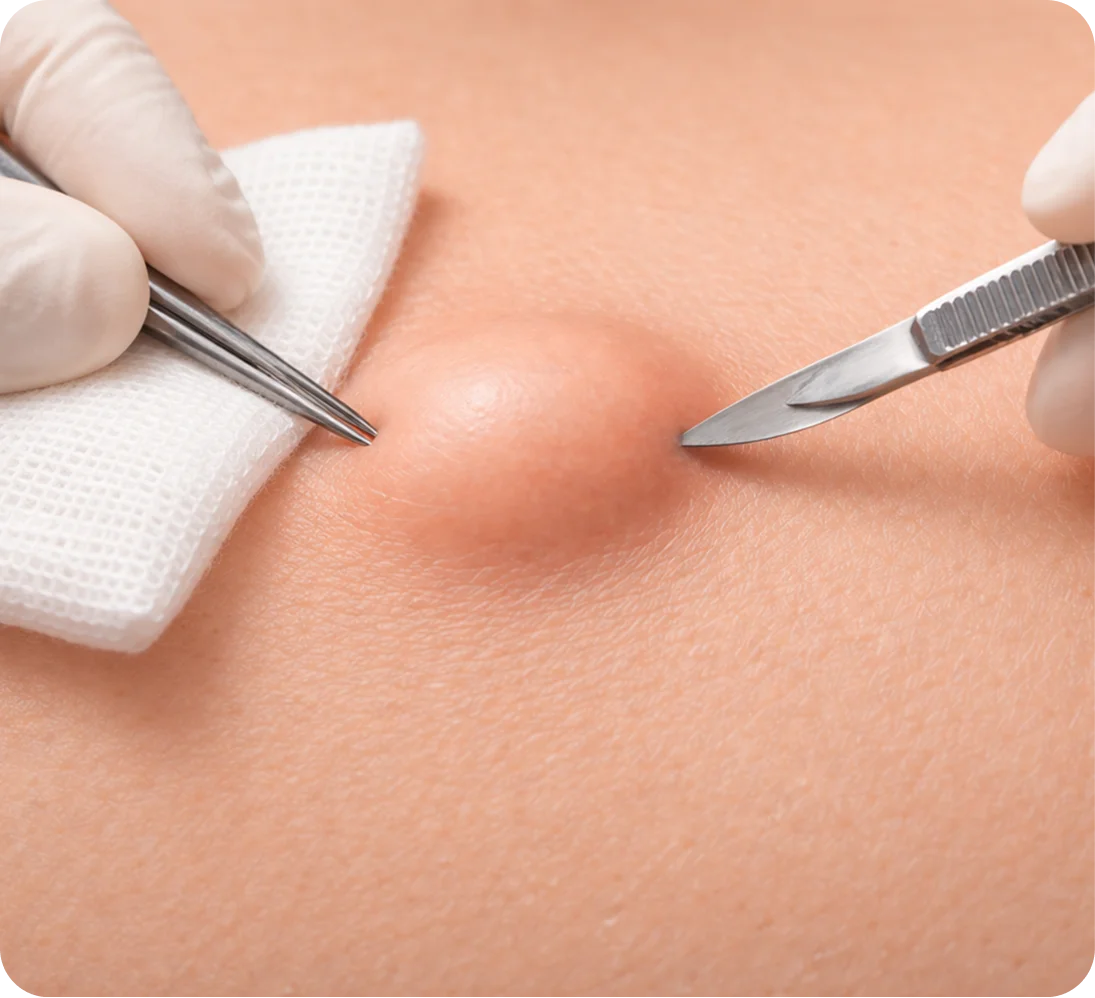Male Hair Transplant