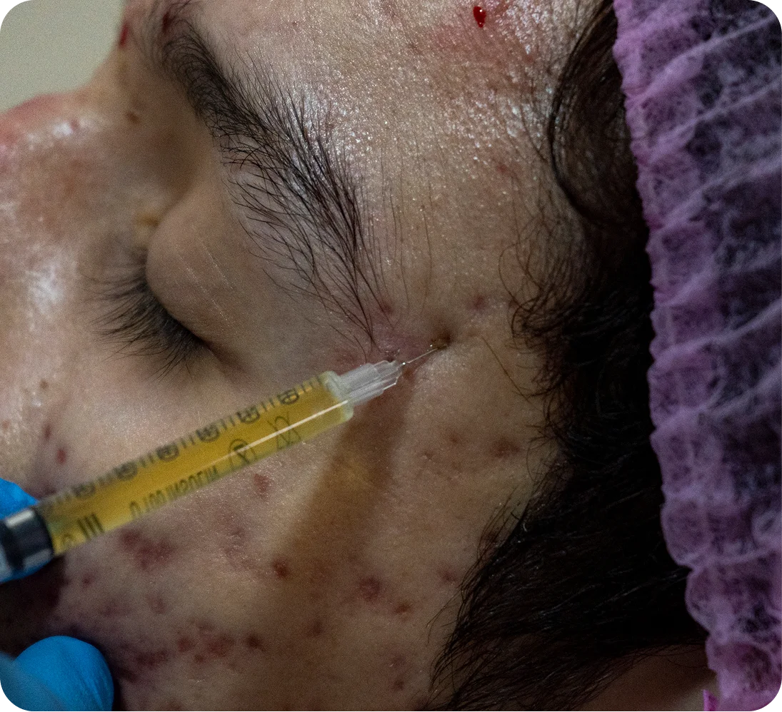 Male Hair Transplant