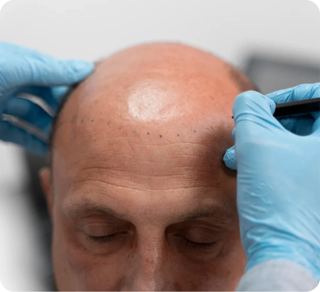 Hairline Reconstruction