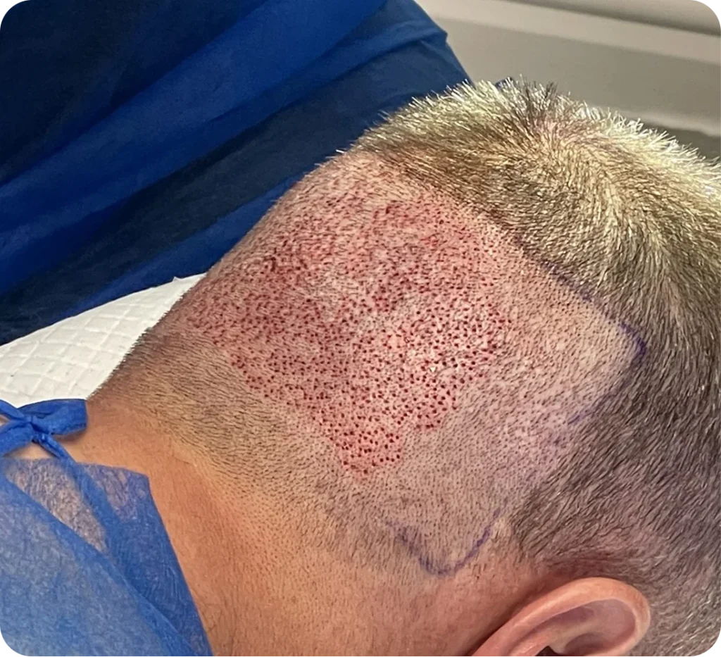 FUE Hair Transplant