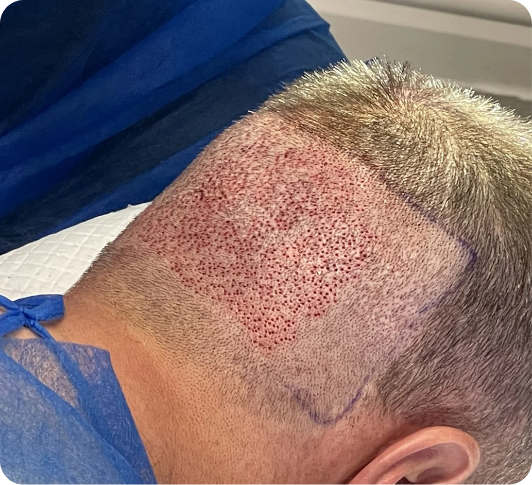 FUE Hair Transplant