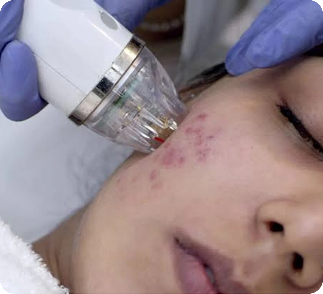 Male Hair Transplant