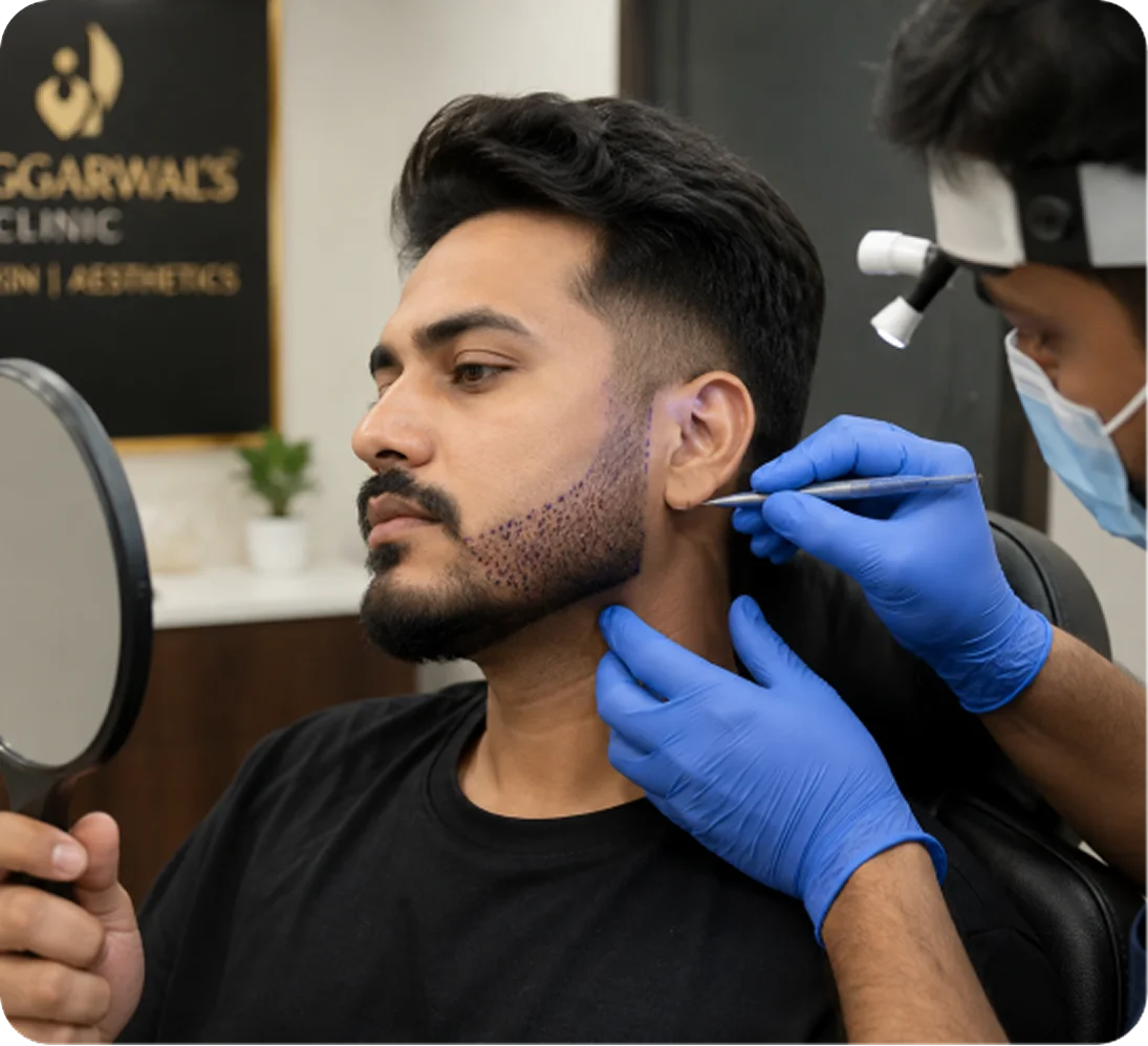 Beard Hair Transplant