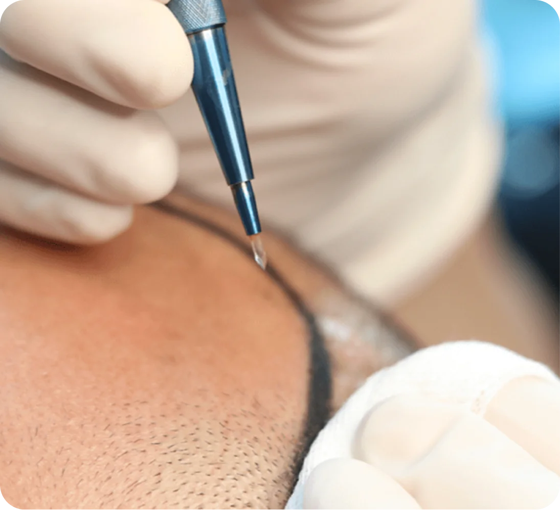 Sapphire FUE Hair Transplant