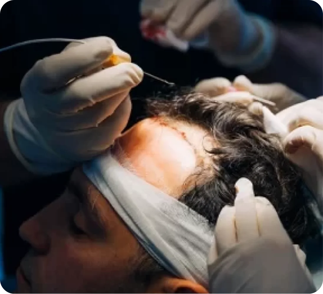 FUE Hair Transplant