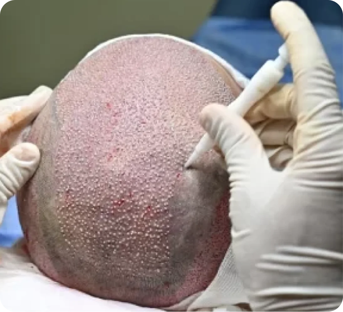 DHI Hair Transplant
